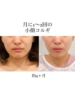 アリュール(Allure)/小顔コルギ（３０代女性）