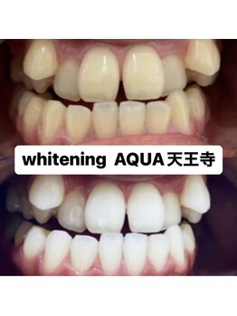 アクア 天王寺店(AQUA)/セルフホワイトニング効果