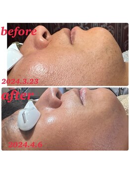 アンレーヴ/ひげ脱毛経過