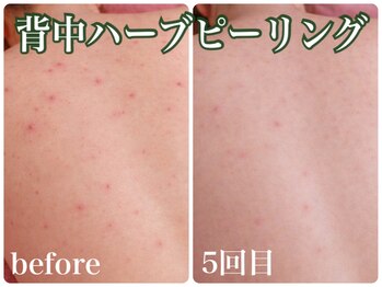 スイ 昭島店(Sui)/背中ハーブピーリング