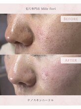 ミルフィオリ(Mille fiori)/ナノスキンマイクロニードル