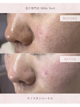ミルフィオリ(Mille fiori)/ナノスキンマイクロニードル