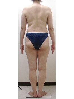 ジョイア 本店(Beauty＆Detox gioia)/松本市40代のお客様ビフォー