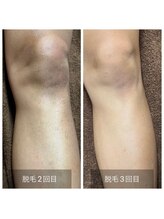 イーエス(E/S)/足脱毛の効果！！