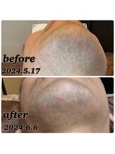 アンレーヴ/ひげ脱毛経過