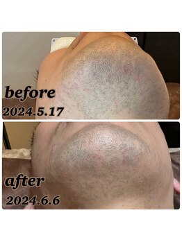 アンレーヴ/ひげ脱毛経過