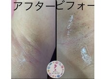 マーメイド/脇脱毛