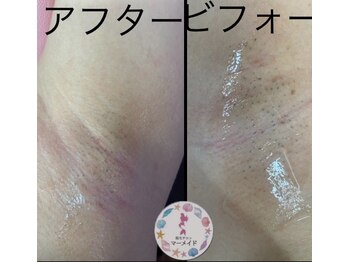 マーメイド/脇脱毛