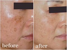 アワピール 成田公津の杜店(AWA PEELL)/ハーブピーリングでシミ改善