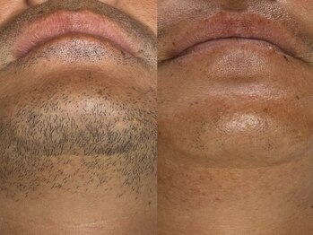 フェリス(FELIZ)/ヒゲ脱毛13回