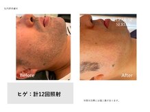 フェレザ 新潟(Felleza)/肌荒れ知らずの脱毛体験