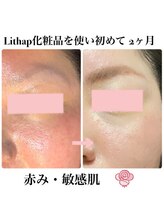 ケンビラク(Kenbiraku 健美楽)/赤み・敏感肌　2か月