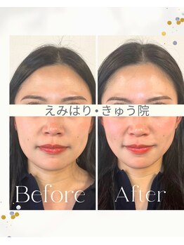 えみはりきゅう院/電気美容鍼とヘッドマッサージ♪