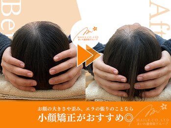 まいれ鍼灸整骨院 整体院 長浜院/小顔矯正ビフォーアフター
