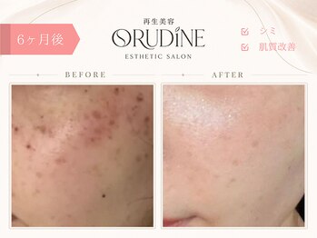 オルディーネ(ORUDiNE)/シミケア透明感