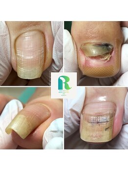 レイ(Ray)の写真/巻き爪や肥厚爪でどこへ行けばいいかわからない方、もう諦めている、そんな方もお待ちしています。