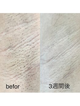 ルル(LuLu)/脇脱毛