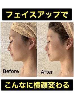 スペチアーレ 夙川/驚きの引上がりで顔がシャープに