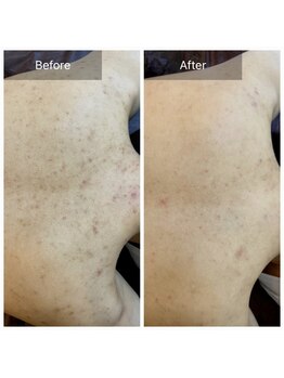 ビビ(VIVI)/背中ニキビケアハーブピーリング