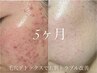 【毛穴×ニキビ改善】ダイヤモンドピーリング+フェイシャルハンドケア60分