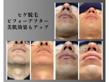 ボゴス 天白店(BOGOSS)/【ヒゲ脱毛】施術写真