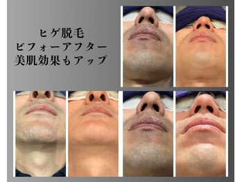 ボゴス 天白店(BOGOSS)/【ヒゲ脱毛】施術写真