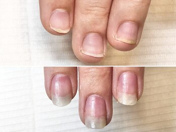 グラシュータン(gracieux temps)/深爪矯正