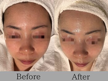 ルミライズ(lumirise)/〈1回目での効果〉