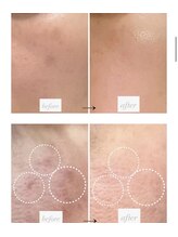 シュシュ(chouchou)/ダクトピール！肌質改善！