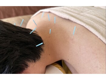 まつもと接骨院 流経大前の写真/身体の不調を鍼灸施術でサポート！肩こり腰痛や自律神経のケアで軽やかな毎日を目指そう★