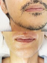 笑顔 上野店/美肌髭脱毛