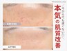 《2回目以降》お悩みに合わせて調合◎剥けないハーブピーリング　¥11000
