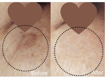 綺麗サロン 脱毛アンドフェイシャル ジュエル(Jewel)/【ポイントシミケア】