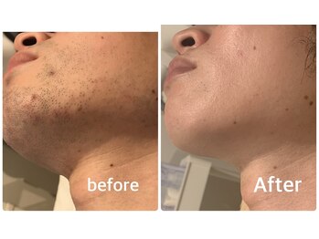 メンズ シャンティ(Men s SHANTI)/【20代男性】脱毛　Before/after