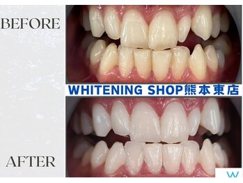 ホワイトニングショップ熊本東店/ホワイトニングショップ熊本東店