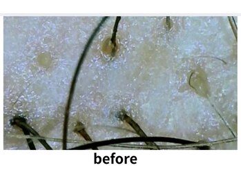 イーズ/リバイタ 梅田本店/【ケース7】30代女性　before