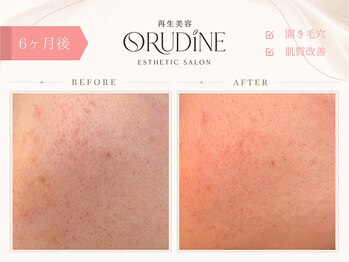 オルディーネ(ORUDiNE)/ 開き毛穴引き締め