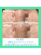 リックス(RIX)/男性 &nbsp;毛穴洗浄♪