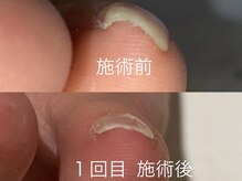 レヴィア(Revia)/巻き爪ケア