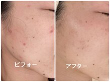 ノーブル シャット Noble Chate/長年お悩みのニキビにアプローチ