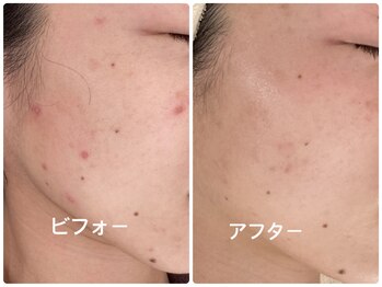 ノーブル シャット Noble Chate/長年お悩みのニキビにアプローチ