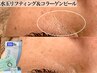 【韓国肌管理メニュー】水玉リフティング&コラーゲンピール　43,000→19,800