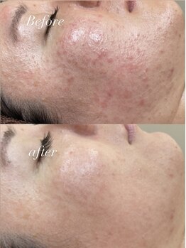 レシェルサロン(Lechelle Salon)/ハーブピーリング＋ダーマエステ