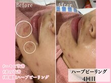 エンクリニカルラボ 京都駅前店(E&N CLINICAL LABO)/幹細胞ハーブピーリング