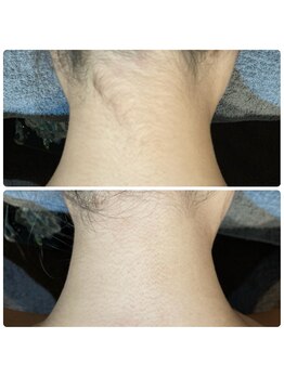 レピア つくば店(LEPIA)/脱毛ビフォーアフター