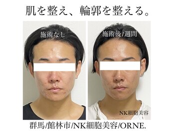 オルネ(ORNE.)/韓国美容**《NK細胞美容》