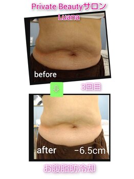 ルアナ(Luana)/脂肪冷却ダイエット！！
