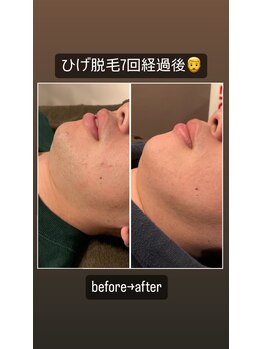 サロン ナビ(salon nabi.)/ひげ脱毛before→after♪