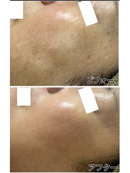 アンジェーム(angeame)/韓国人のような水光肌へ♪