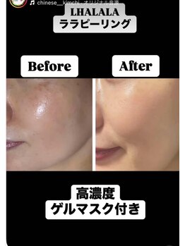 フーレスト アンド フリーリー(Fullest&Freely)/ララピール